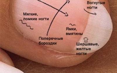 Білий колір нігтів говорить про анемії або про проблеми з нирками.