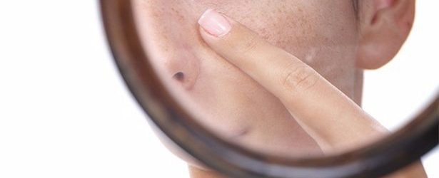 Як звузити пори на шкірі: 10 простих способів