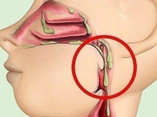Прості способи позбавлення від слизу в організмі.