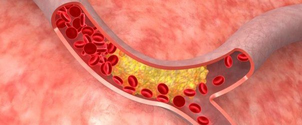 НЕБЕЗПЕКА ГУСТИЙ КРОВІ. Профілактика тромбозу і рецепти для розрідження крові