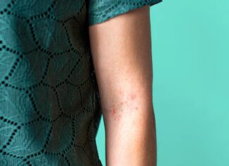 De ziekte van Crohn en de onverwachte impact ervan op de gezondheid van de huid