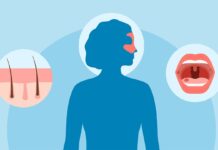 Вовчак і шкірні прояви: повний посібник