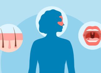 Lupus und Hautsymptome: Ein umfassender Leitfaden