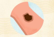 Melanoma: una guida completa a sintomi, diagnosi e trattamento