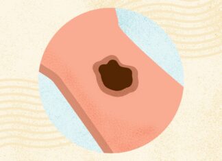 Melanom: Ein umfassender Leitfaden zu Symptomen, Diagnose und Behandlung