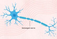 Хроническая Воспалительная Демиелинизирующая Полирадикулоневропатия (ХВДП): Обзор