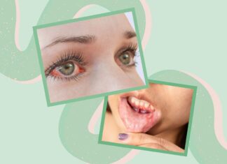 Sinais inesperados de que a doença de Crohn está piorando