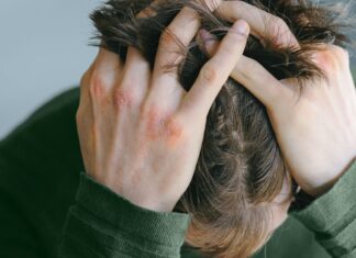 Atopic Dermatitis: Overcoming Treatment Fatigue