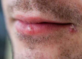 Las raras afecciones de la piel que realmente preocupan a los médicos